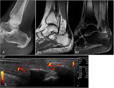 Recent Advances in Imaging for Diagnosis, Monitoring, and Prognosis of Psoriatic Arthritis